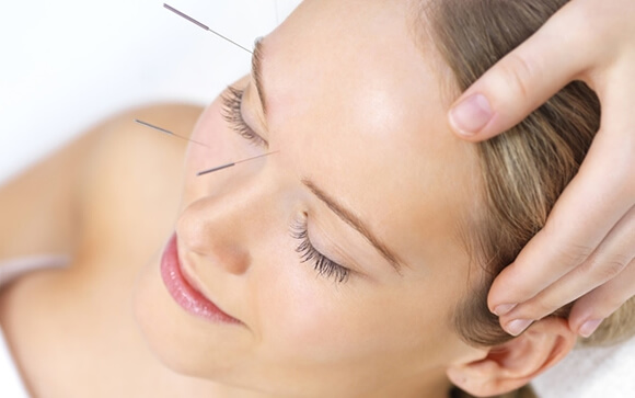 Acupuntura facial